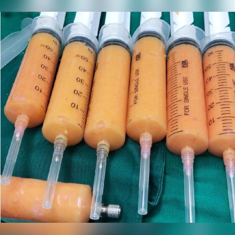 最新注射隆胸技术，重塑胸部形态的优选方案