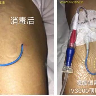 PICC换药步骤、技巧及注意事项最新视频教程